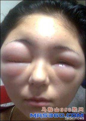 染发剂的过敏反应可能会非常可怕。科尔本的头和眼睛严重肿胀，她看东西都很困难